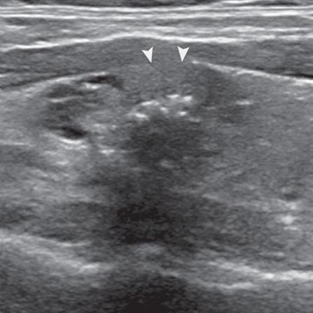 Pic2_Suspicious_Minor_Extrathyroidal_Extension.jpeg