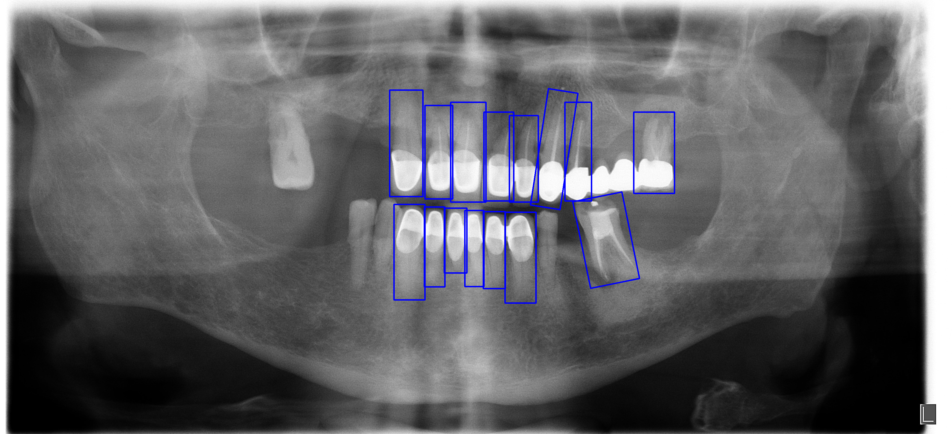 An AU-OPG radiograph with tooth-aligned annotations