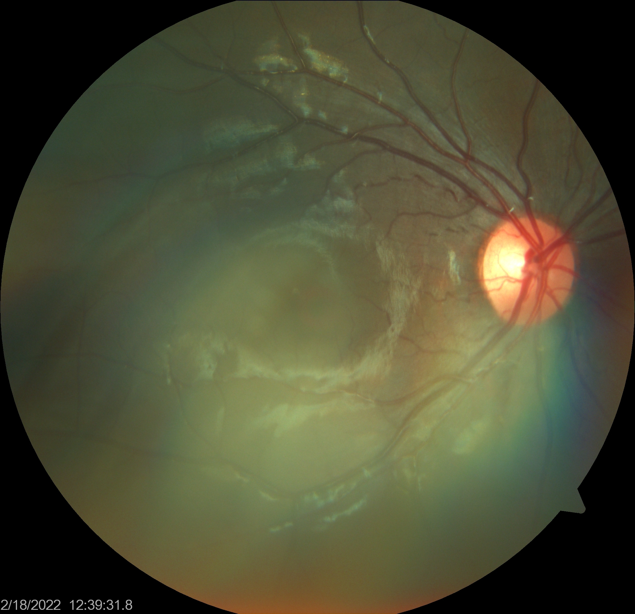 test-glaucoma-image2.jpg